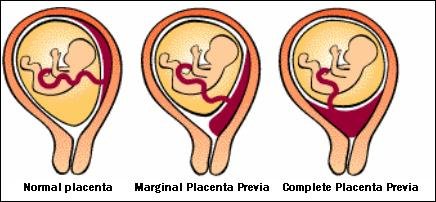 placentaprevia2.jpg