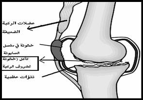 arthritisknee.jpg