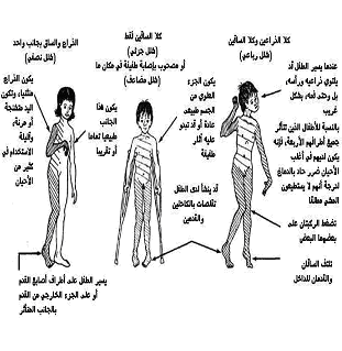 مرض شلل الأطفال polio الساحة العلمية أخوات طريق الإسلام